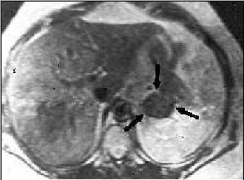Hình ảnh chụp cộng hưởng từ thấy khối u tại tuyến thượng thận
