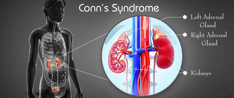 Bệnh hội chứng Conn là gì? Triệu chứng và cách điều trị
