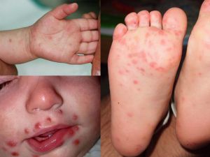 Bệnh chân tay miệng ở trẻ em