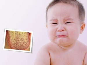 Bệnh nấm lưỡi ở trẻ em