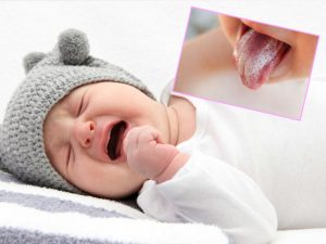 Chữa tưa lưỡi cho trẻ sơ sinh