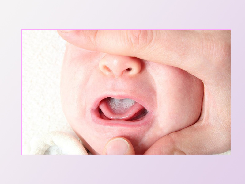 Hình ảnh: Trẻ sơ sinh bị nấm lưỡi nhẹ