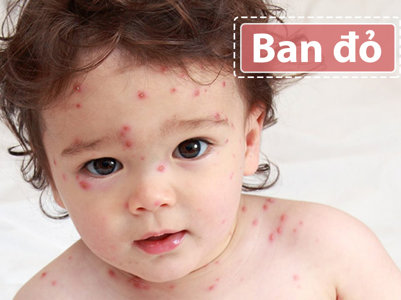 Ban đỏ nhiễm độc ở trẻ sơ sinh gây ra tình trạng nổi mẩn đỏ ở mặt trẻ